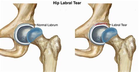 acetabular labral tear orthopedic test|acetabular labral tear surgery recovery.